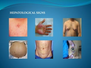 HEPATOLOGICAL SIGNS
 