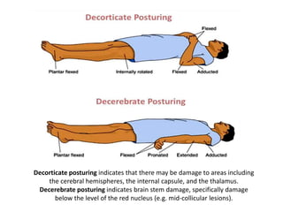Posturing Types Brain Injury Approach to unconsciousness | PPTX