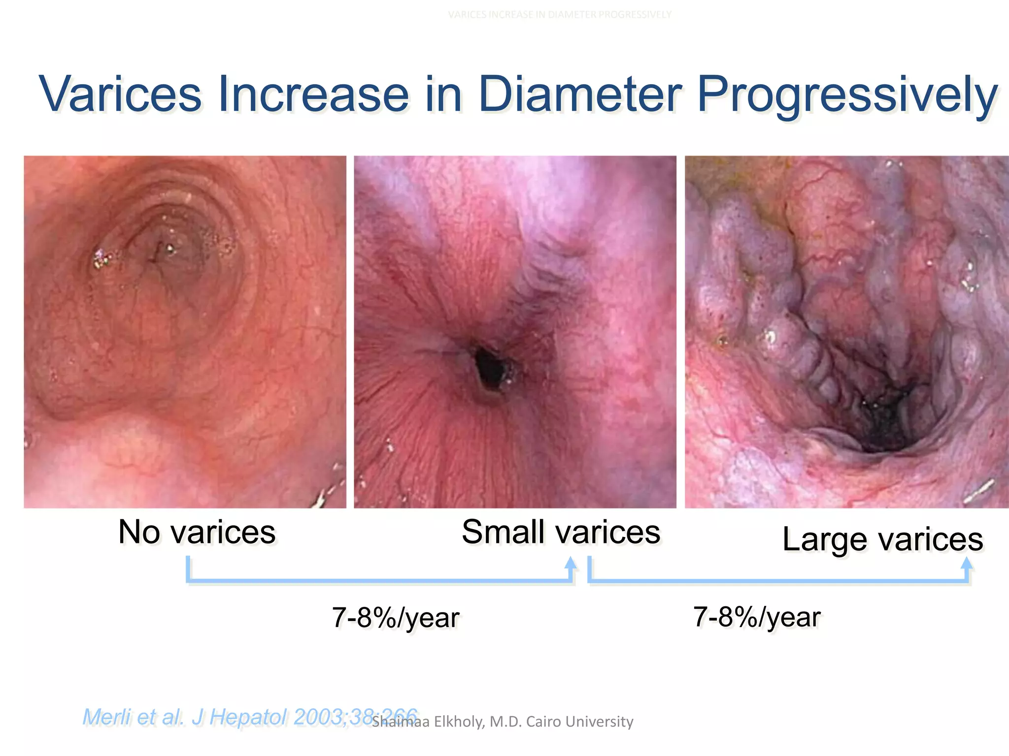 Small varices Large varicesNo varices
7-8%/year 7-8%/year
Varices Increase in Diameter Progressively
Merli et al. J Hepatol 2003;38:266
VARICES INCREASE IN DIAMETER PROGRESSIVELY
Shaimaa Elkholy, M.D. Cairo University
 