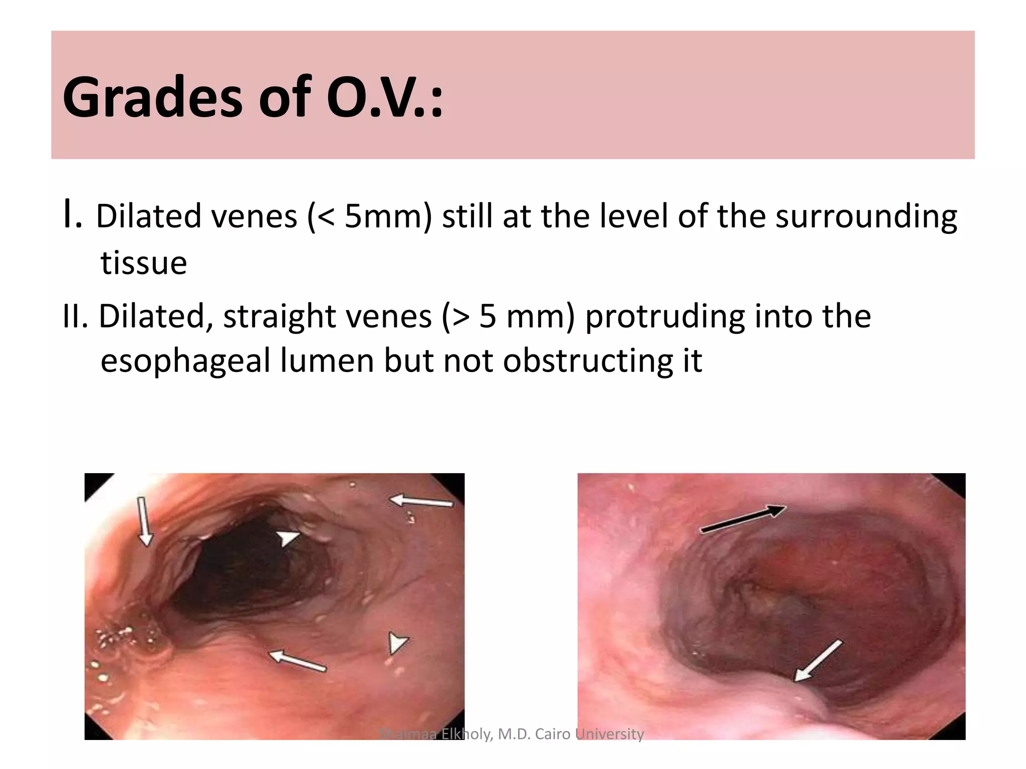 I. Dilated venes (< 5mm) still at the level of the surrounding
tissue
II. Dilated, straight venes (> 5 mm) protruding into the
esophageal lumen but not obstructing it
Grades of O.V.:
Shaimaa Elkholy, M.D. Cairo University
 