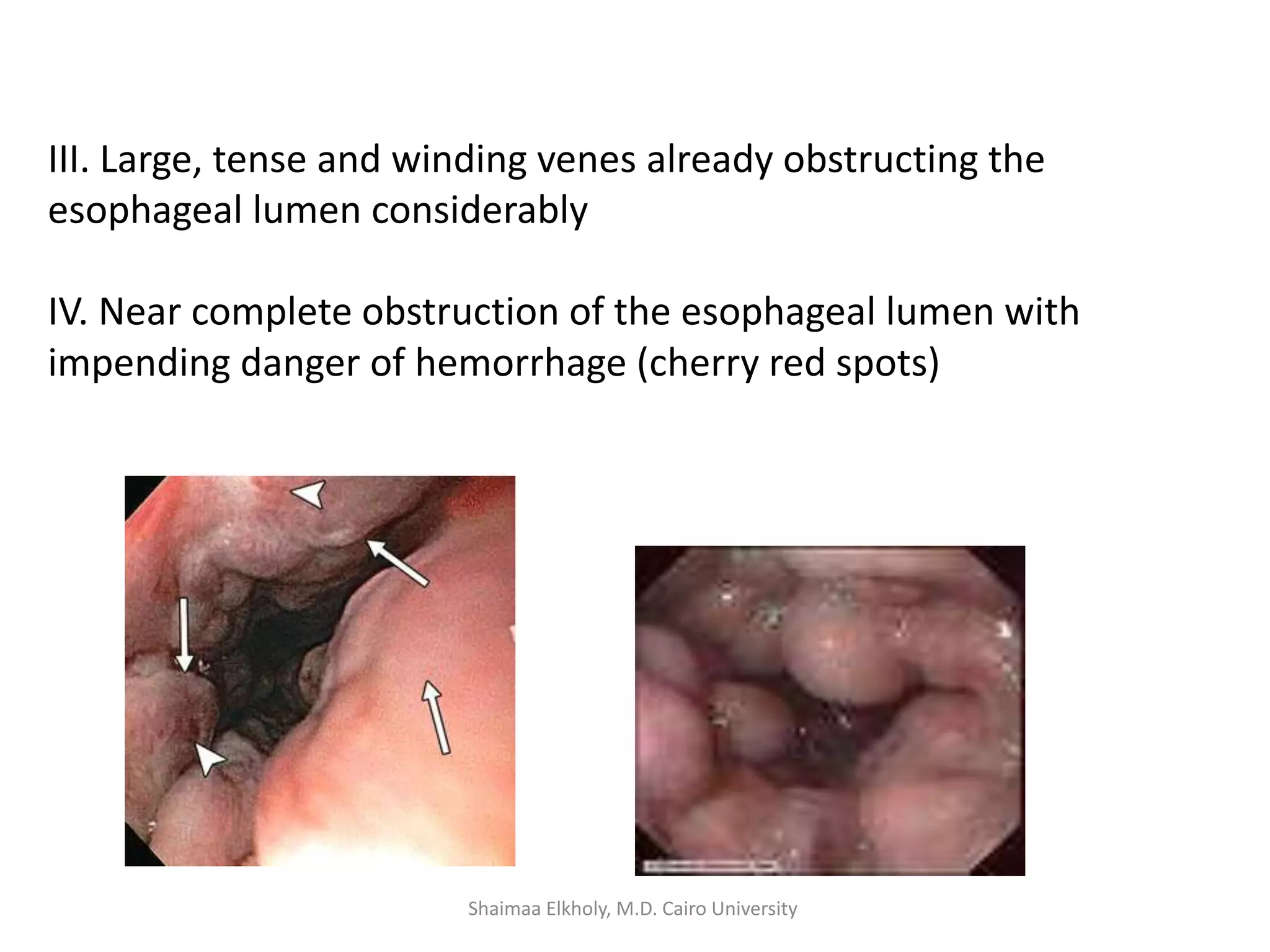 III. Large, tense and winding venes already obstructing the
esophageal lumen considerably
IV. Near complete obstruction of the esophageal lumen with
impending danger of hemorrhage (cherry red spots)
Shaimaa Elkholy, M.D. Cairo University
 