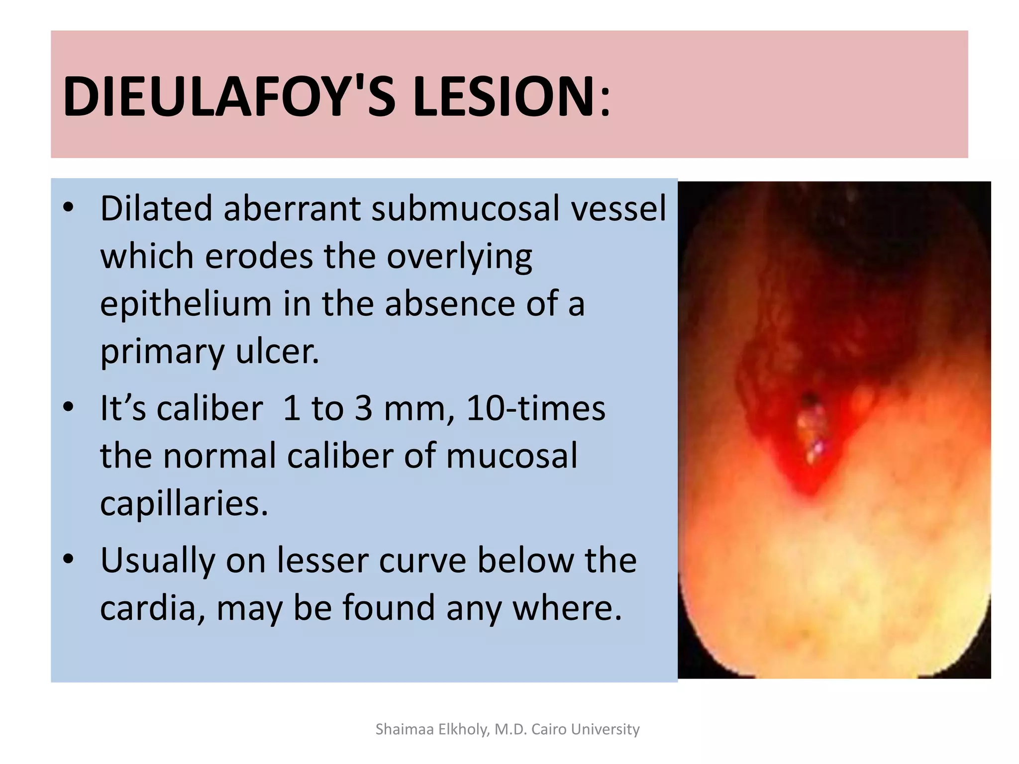 DIEULAFOY'S LESION:
• Dilated aberrant submucosal vessel
which erodes the overlying
epithelium in the absence of a
primary ulcer.
• It’s caliber 1 to 3 mm, 10-times
the normal caliber of mucosal
capillaries.
• Usually on lesser curve below the
cardia, may be found any where.
Shaimaa Elkholy, M.D. Cairo University
 