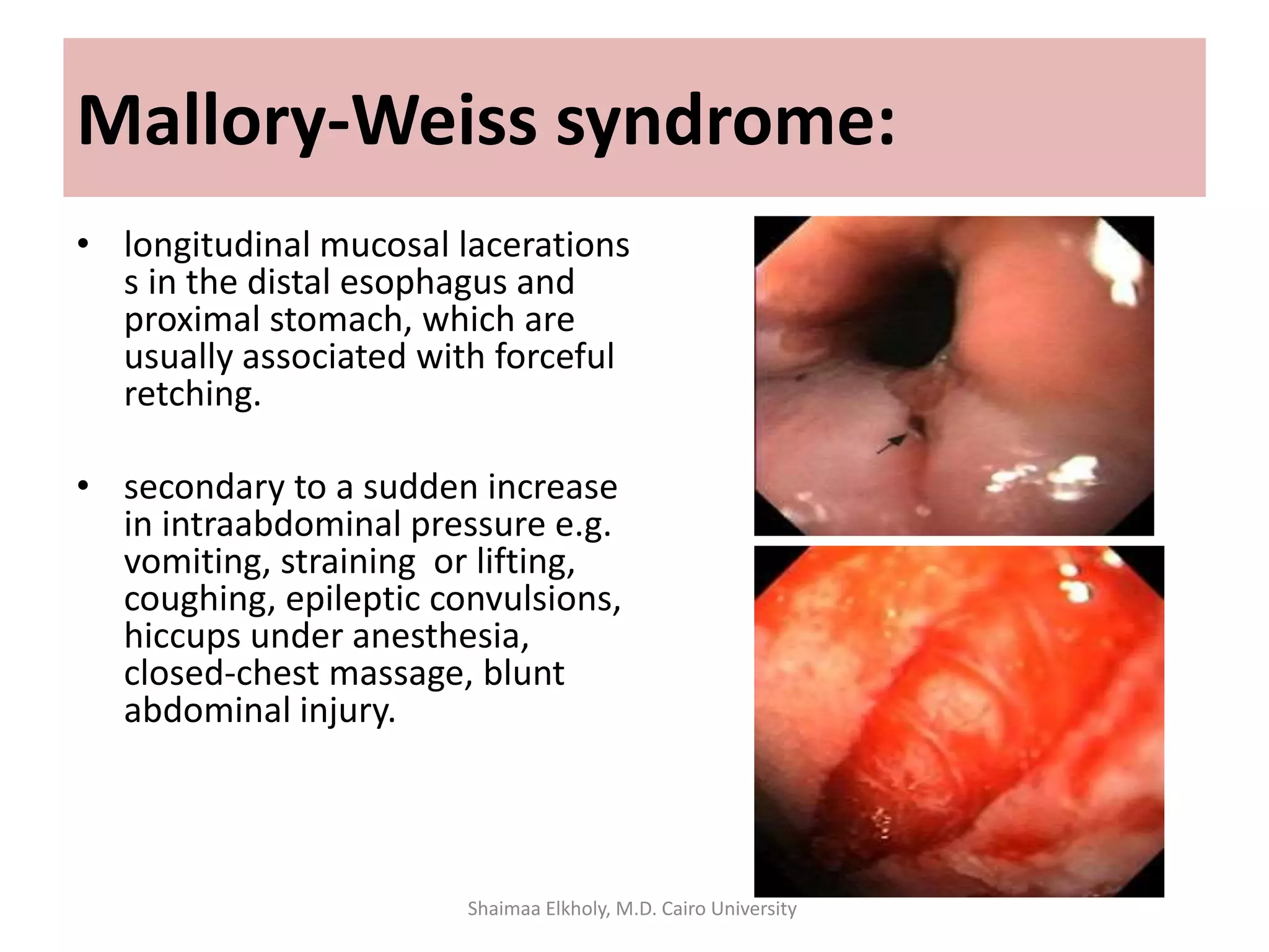 Mallory-Weiss syndrome:
• longitudinal mucosal lacerations
s in the distal esophagus and
proximal stomach, which are
usually associated with forceful
retching.
• secondary to a sudden increase
in intraabdominal pressure e.g.
vomiting, straining or lifting,
coughing, epileptic convulsions,
hiccups under anesthesia,
closed-chest massage, blunt
abdominal injury.
Shaimaa Elkholy, M.D. Cairo University
 