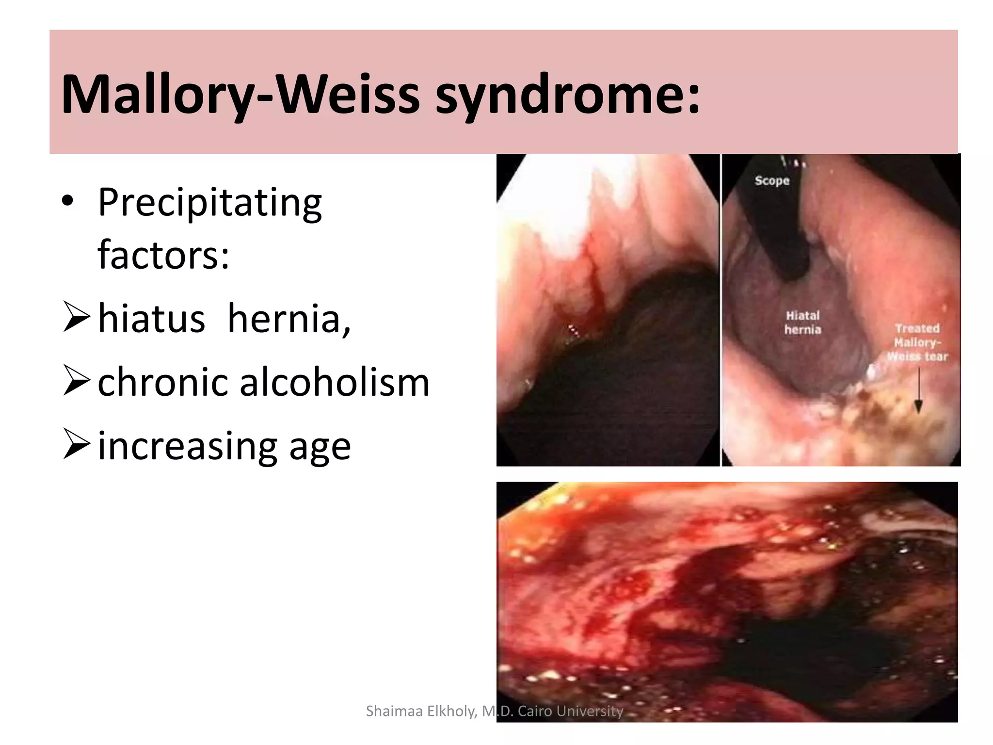 • Precipitating
factors:
hiatus hernia,
chronic alcoholism
increasing age
Mallory-Weiss syndrome:
Shaimaa Elkholy, M.D. Cairo University
 