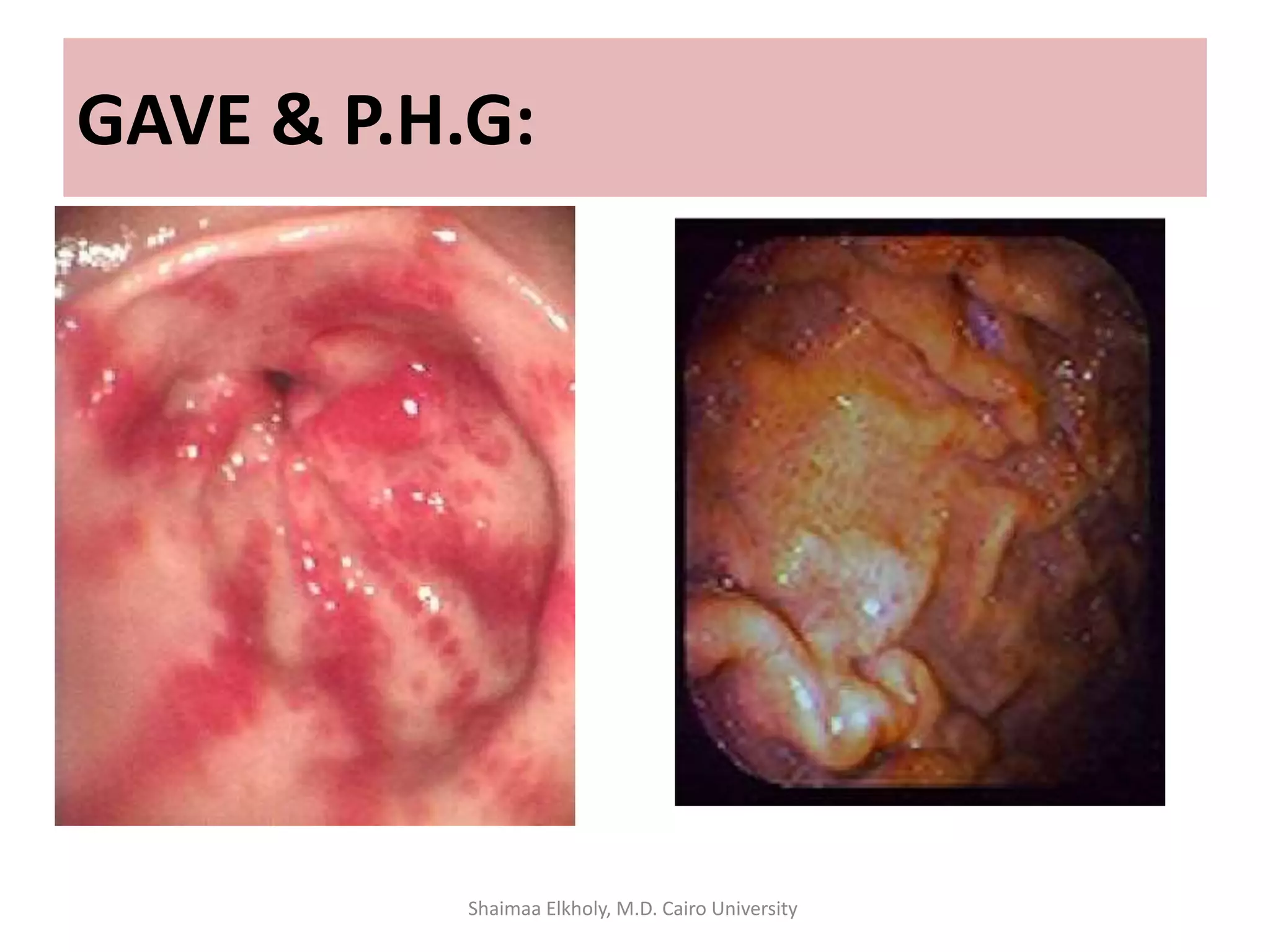 GAVE & P.H.G:
Shaimaa Elkholy, M.D. Cairo University
 