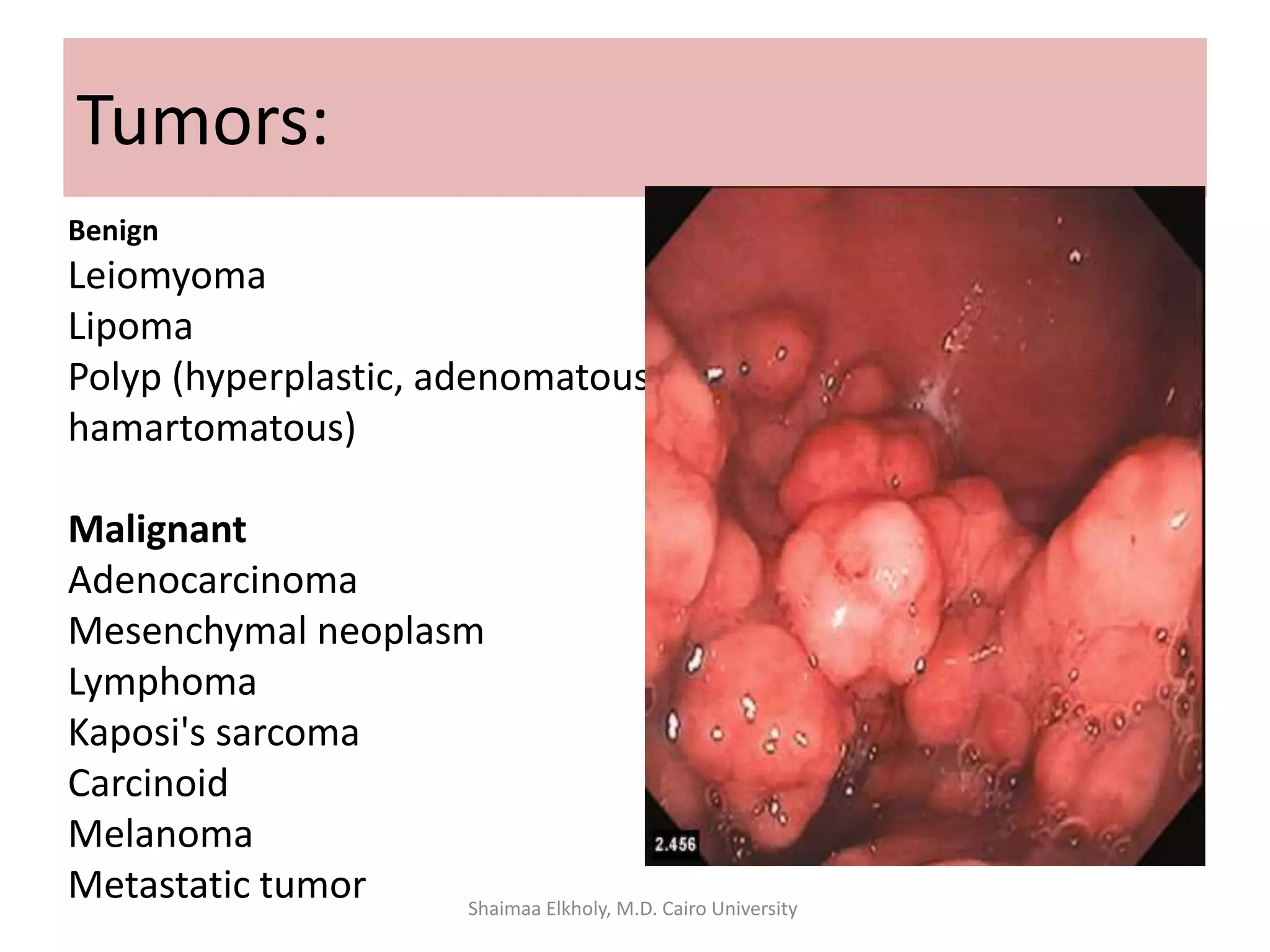 Tumors:
Benign
Leiomyoma
Lipoma
Polyp (hyperplastic, adenomatous,
hamartomatous)
Malignant
Adenocarcinoma
Mesenchymal neoplasm
Lymphoma
Kaposi's sarcoma
Carcinoid
Melanoma
Metastatic tumor Shaimaa Elkholy, M.D. Cairo University
 