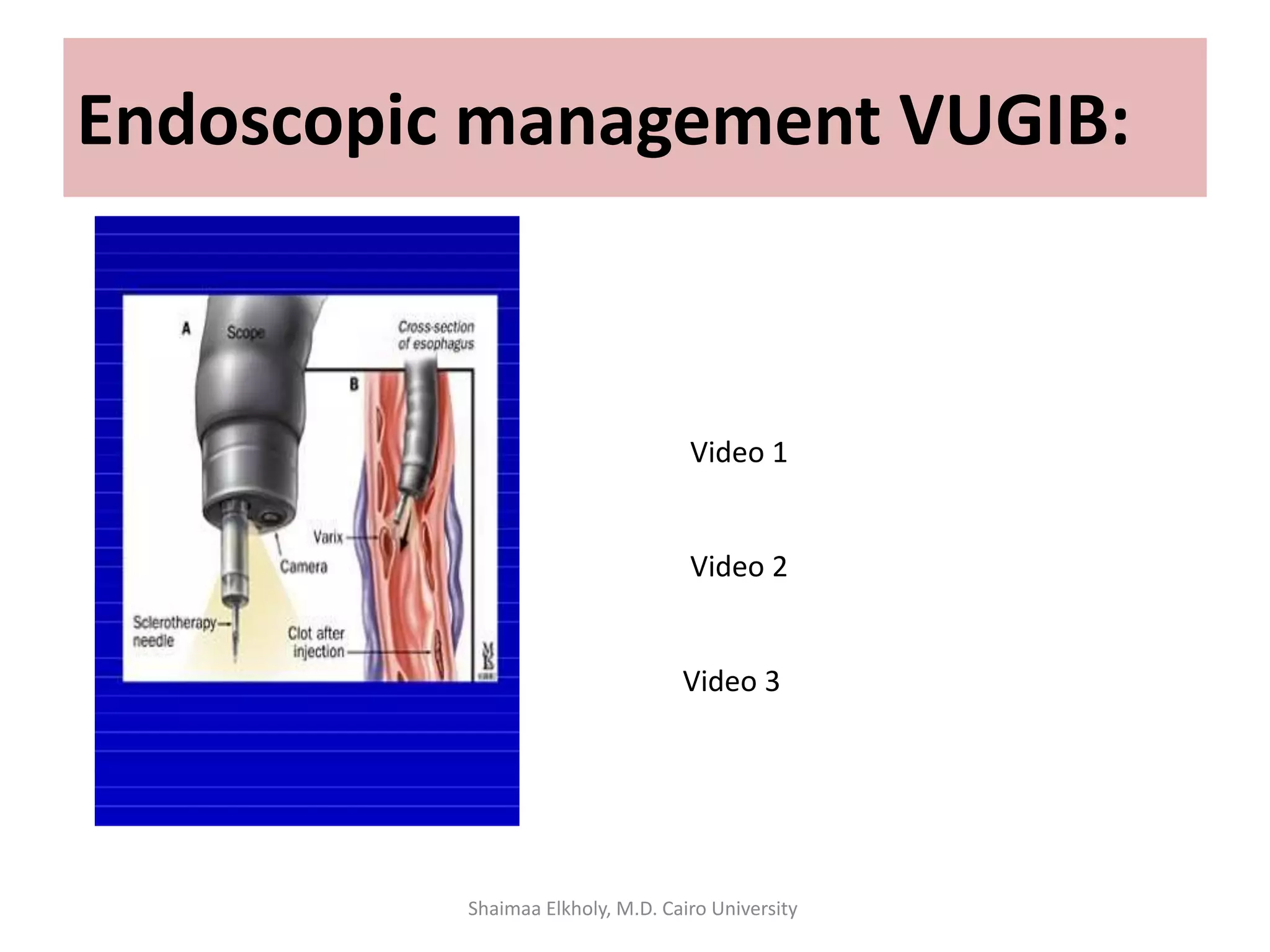 Endoscopic management VUGIB:
Video 1
Video 2
Video 3
Shaimaa Elkholy, M.D. Cairo University
 