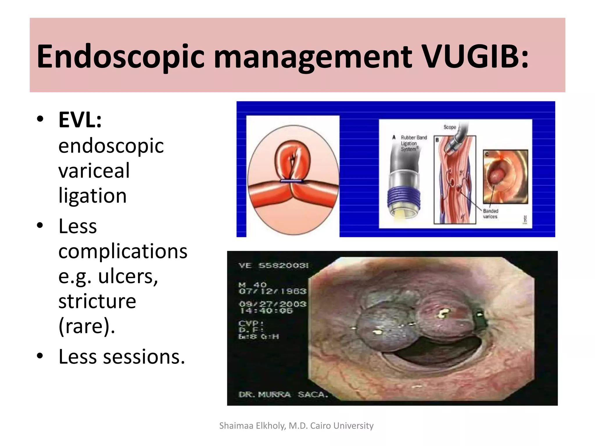 • EVL:
endoscopic
variceal
ligation
• Less
complications
e.g. ulcers,
stricture
(rare).
• Less sessions.
Endoscopic management VUGIB:
Shaimaa Elkholy, M.D. Cairo University
 
