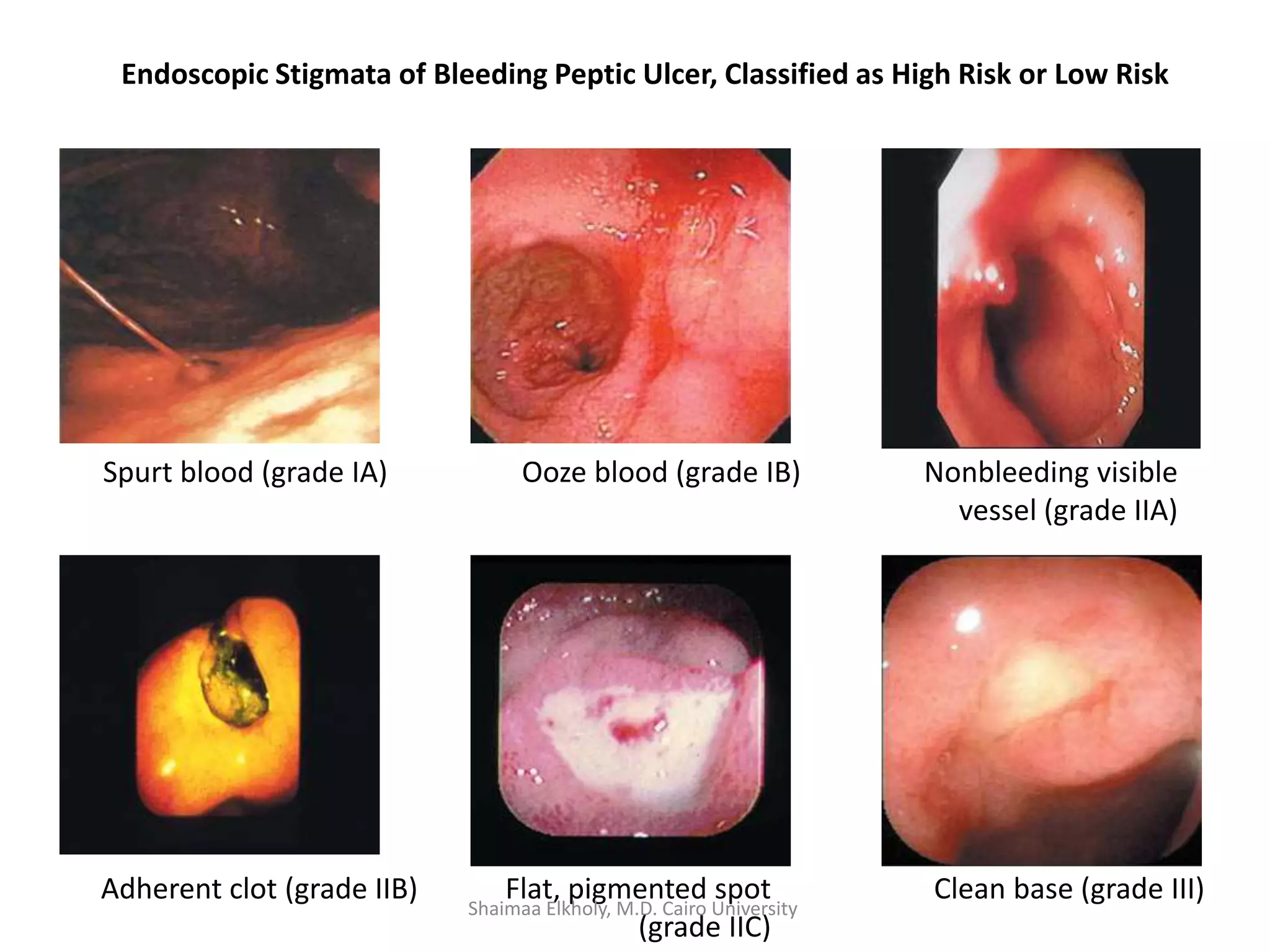 Endoscopic Stigmata of Bleeding Peptic Ulcer, Classified as High Risk or Low Risk
Spurt blood (grade IA) Ooze blood (grade IB) Nonbleeding visible
vessel (grade IIA)
Adherent clot (grade IIB) Flat, pigmented spot
(grade IIC)
Clean base (grade III)
Shaimaa Elkholy, M.D. Cairo University
 