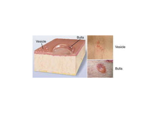Approach to vesiculo bullous papular lesion in neonates | PPTX