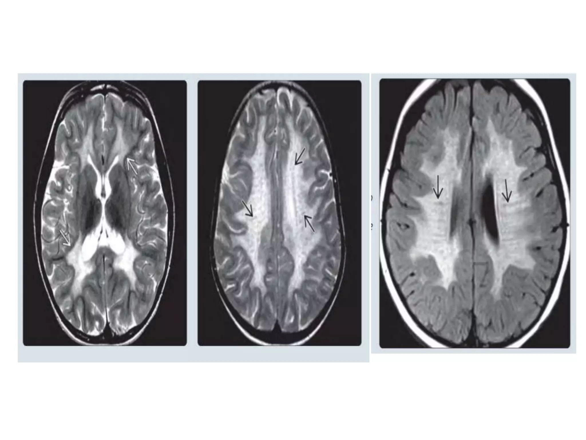 Approach to white matter disease | PPTX