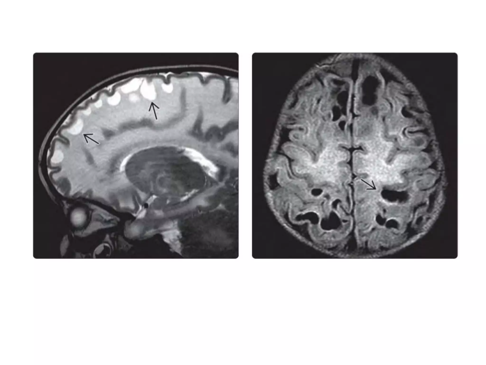 Approach to white matter disease | PPT