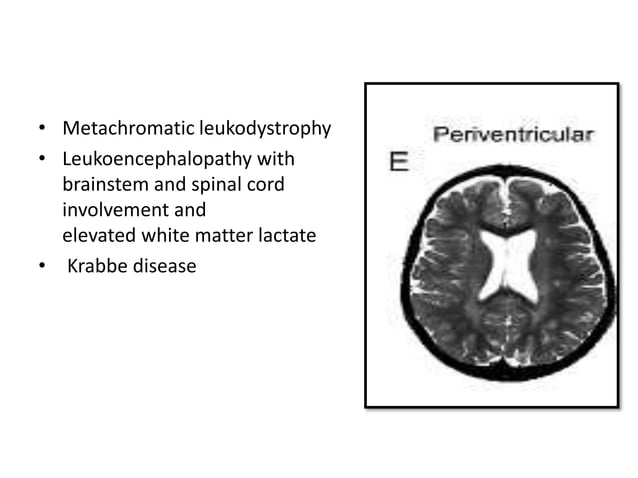 Approach to white matter disease | PPTX | Brain and Nervous System ...