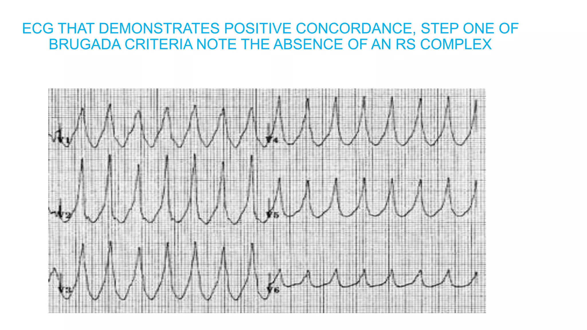 APPROACH TO WIDE QRS COMPLEXTACHYCARDIA.pptx