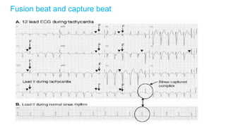 APPROACH TO WIDE QRS COMPLEXTACHYCARDIA.pptx
