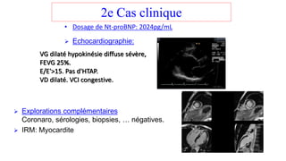 2e Cas clinique
• Dosage de Nt-proBNP: 2024pg/mL
➢ Echocardiographie:
➢ Explorations complémentaires
Coronaro, sérologies, biopsies, … négatives.
➢ IRM: Myocardite
VG dilaté hypokinésie diffuse sévère,
FEVG 25%.
E/E'>15. Pas d'HTAP.
VD dilaté. VCI congestive.
 