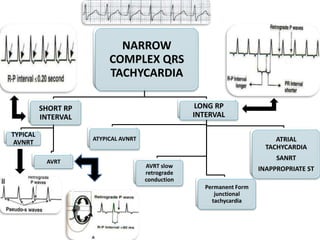 Approch narrow complex tachycardia | PPTX