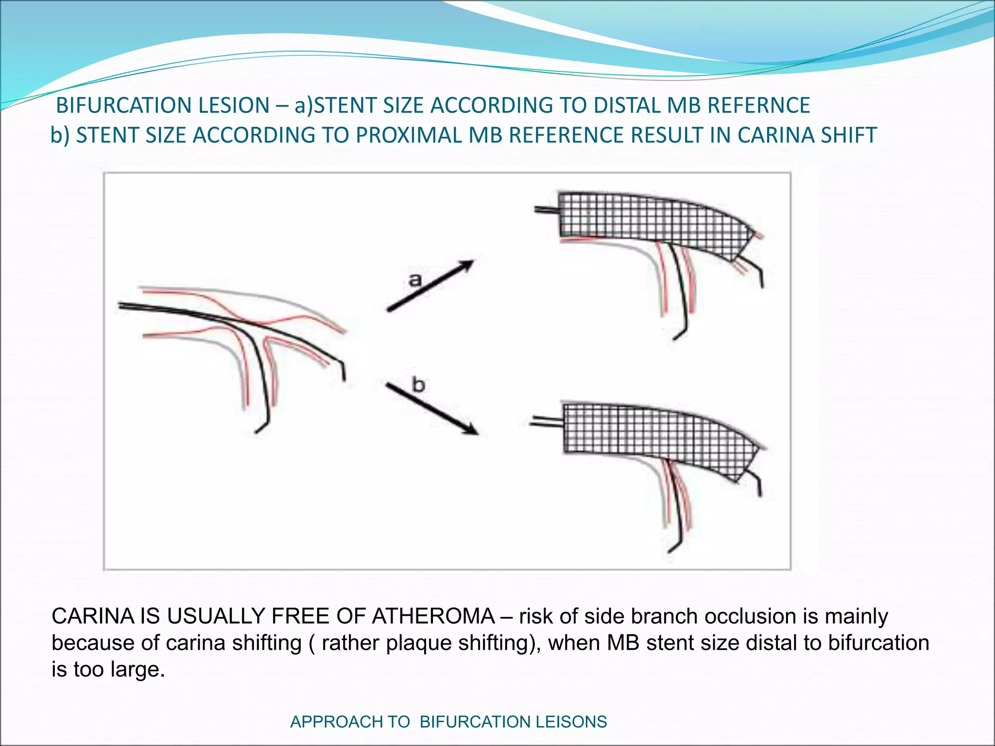 BIFURCATION LESION – a)STENT SIZE ACCORDING TO DISTAL MB REFERNCE
b) STENT SIZE ACCORDING TO PROXIMAL MB REFERENCE RESULT IN CARINA SHIFT
APPROACH TO BIFURCATION LEISONS
CARINA IS USUALLY FREE OF ATHEROMA – risk of side branch occlusion is mainly
because of carina shifting ( rather plaque shifting), when MB stent size distal to bifurcation
is too large.
 