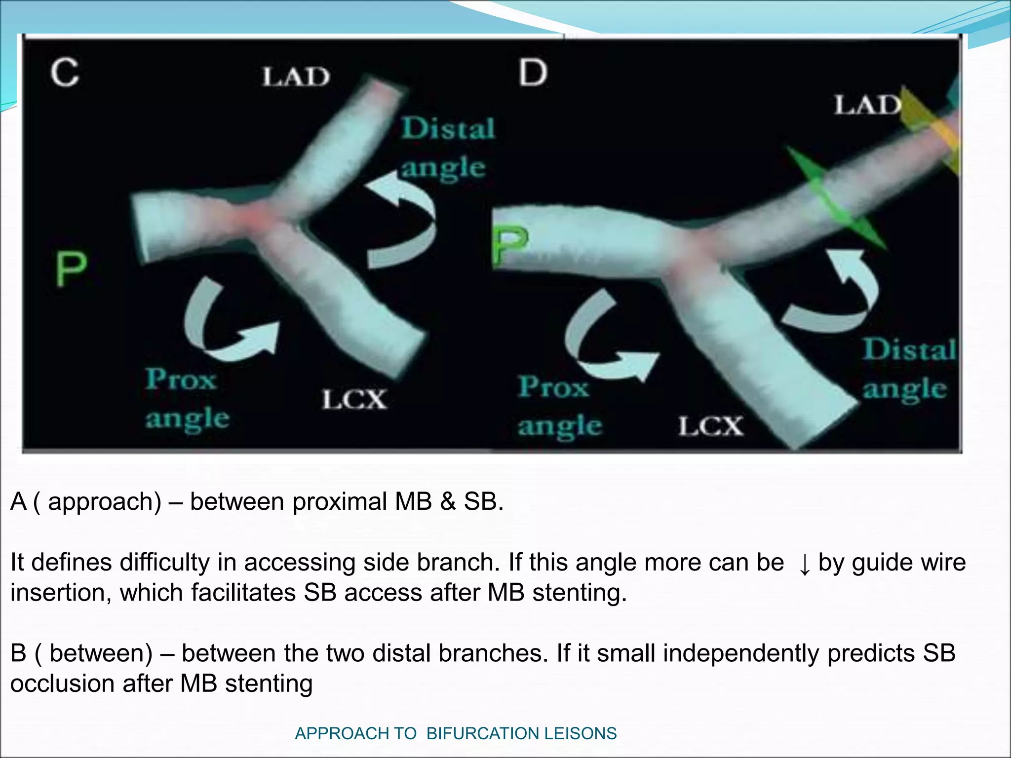 APPROACH TO BIFURCATION LEISONS
A ( approach) – between proximal MB & SB.
It defines difficulty in accessing side branch. If this angle more can be ↓ by guide wire
insertion, which facilitates SB access after MB stenting.
B ( between) – between the two distal branches. If it small independently predicts SB
occlusion after MB stenting
 