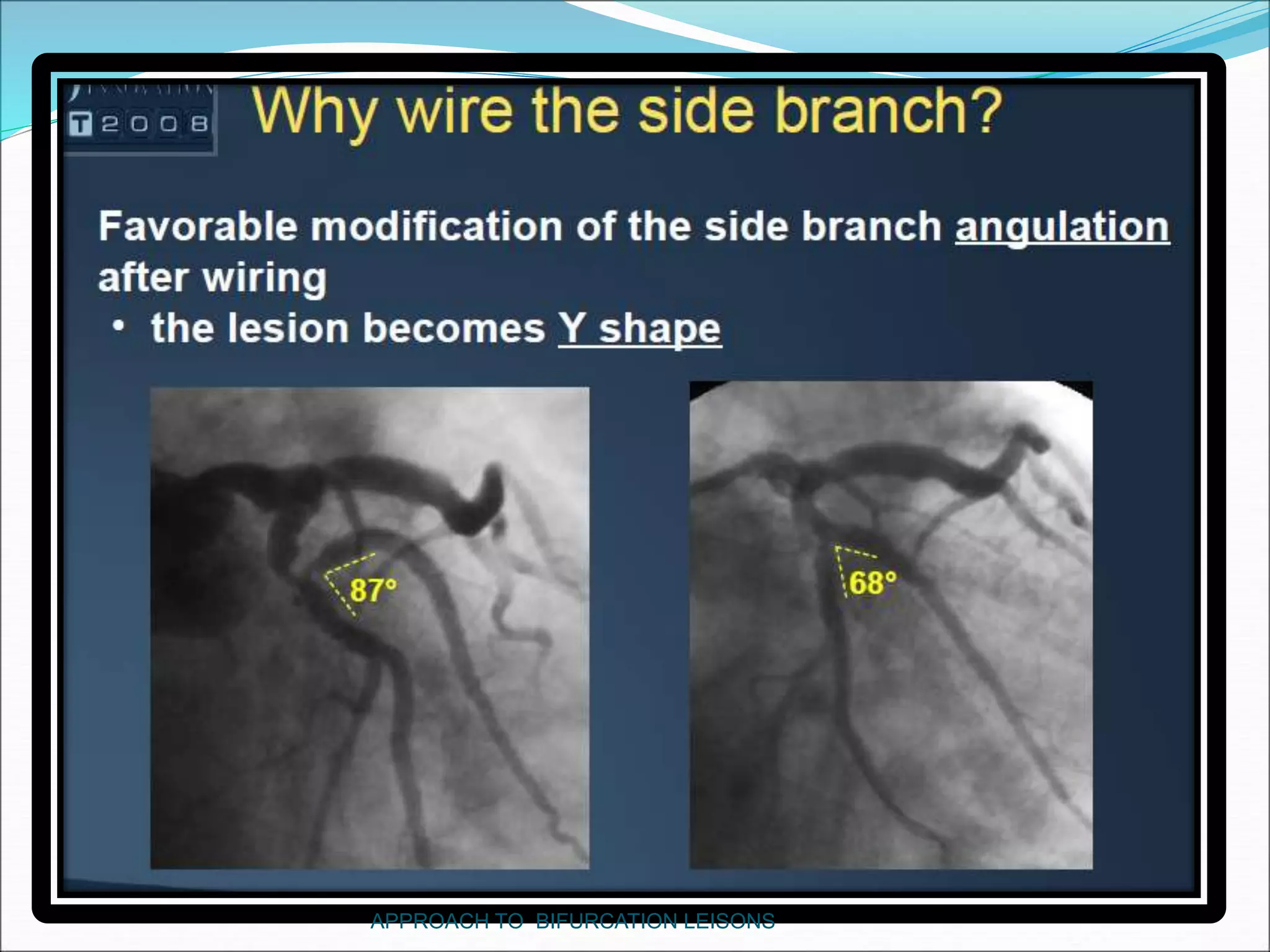 APPROACH TO BIFURCATION LEISONS
 