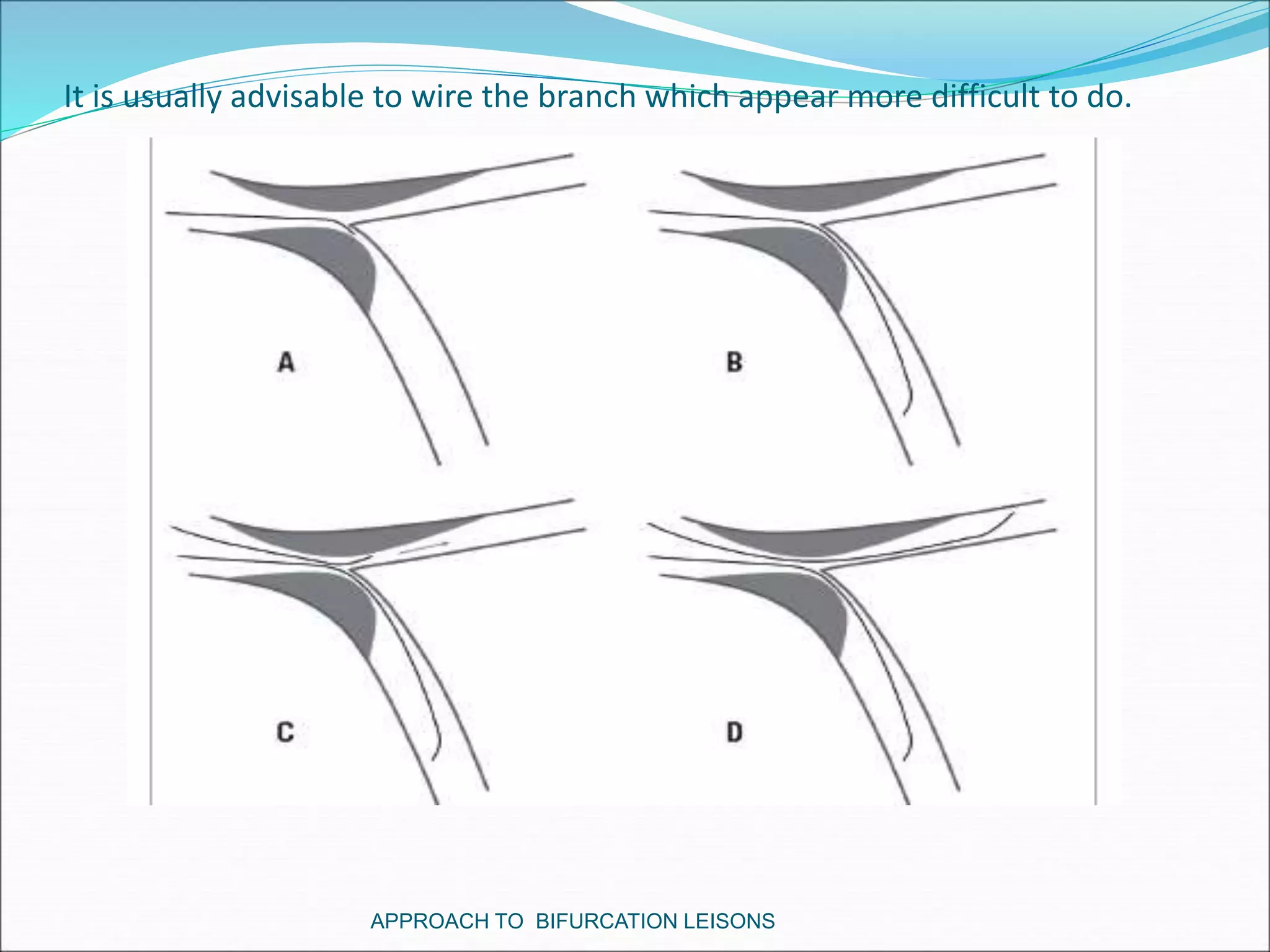 It is usually advisable to wire the branch which appear more difficult to do.
APPROACH TO BIFURCATION LEISONS
 