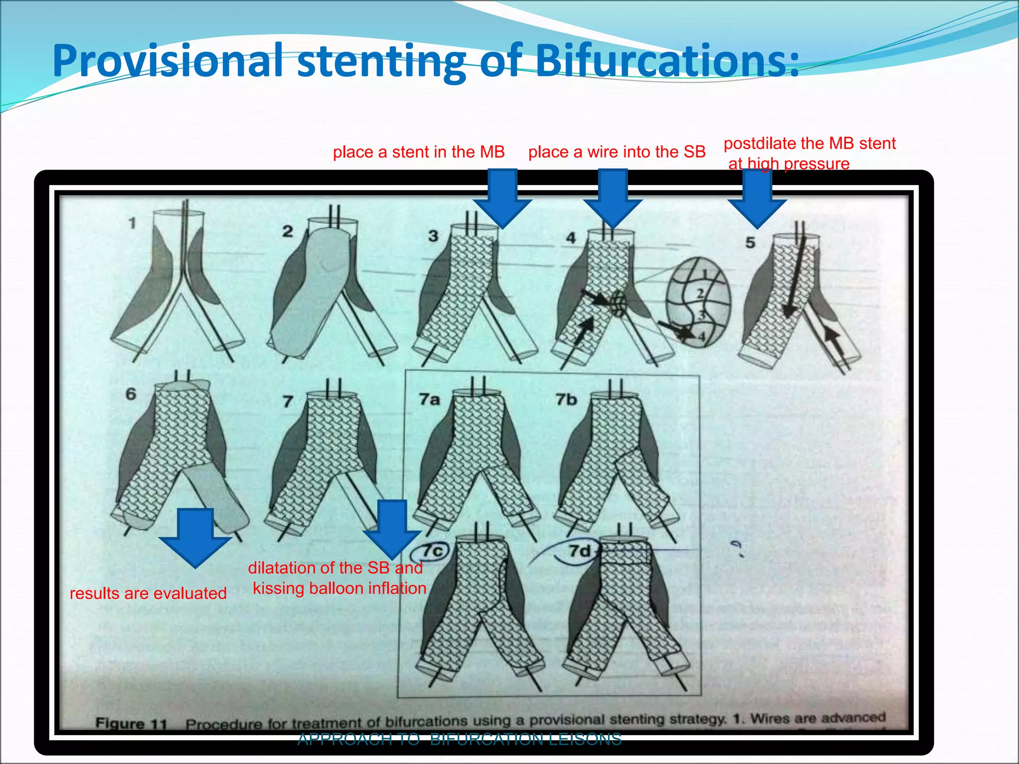 Provisional stenting of Bifurcations:
place a stent in the MB
postdilate the MB stent
at high pressure
place a wire into the SB
results are evaluated
dilatation of the SB and
kissing balloon inflation
APPROACH TO BIFURCATION LEISONS
 