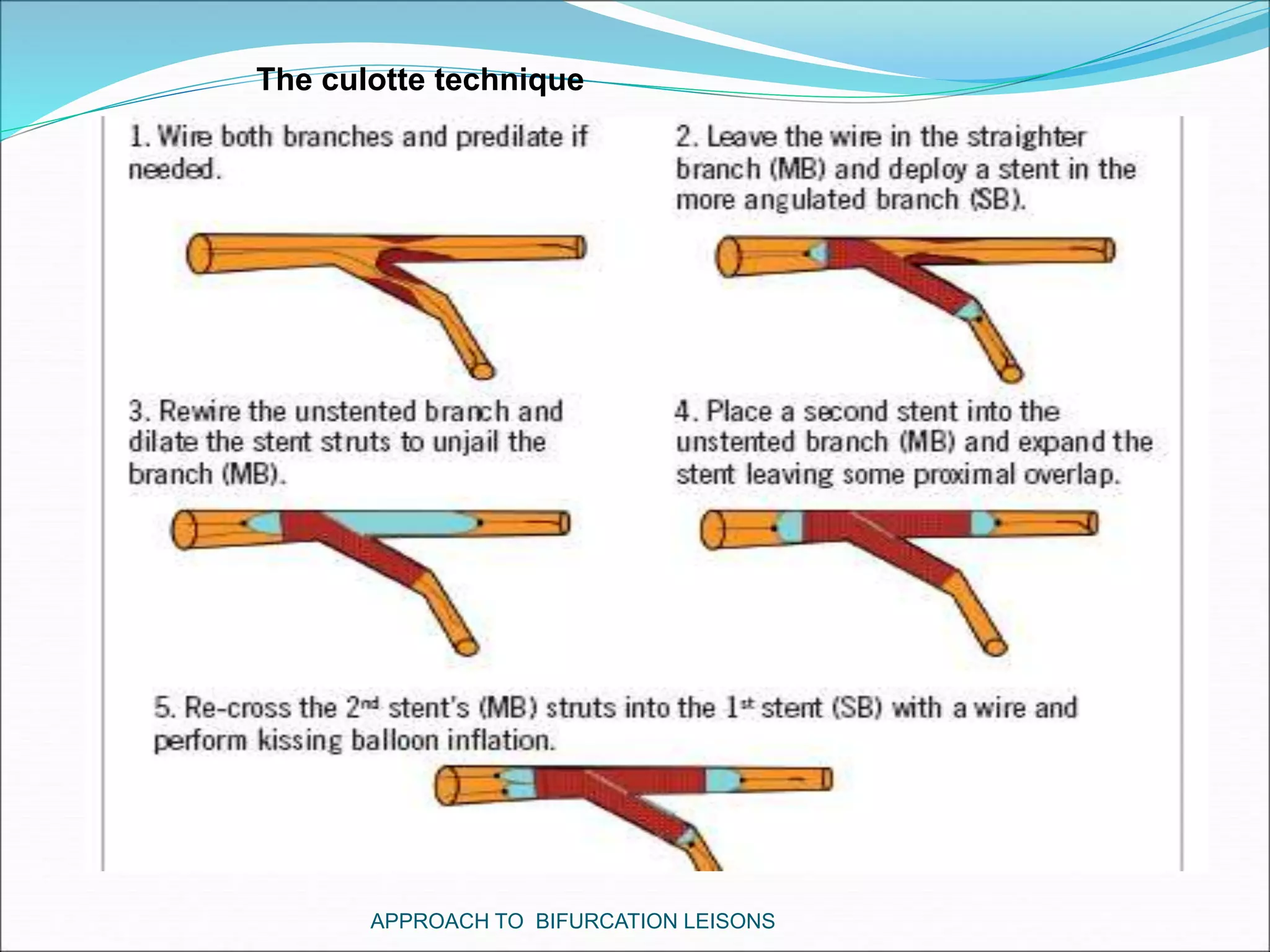 APPROACH TO BIFURCATION LEISONS
The culotte technique
 