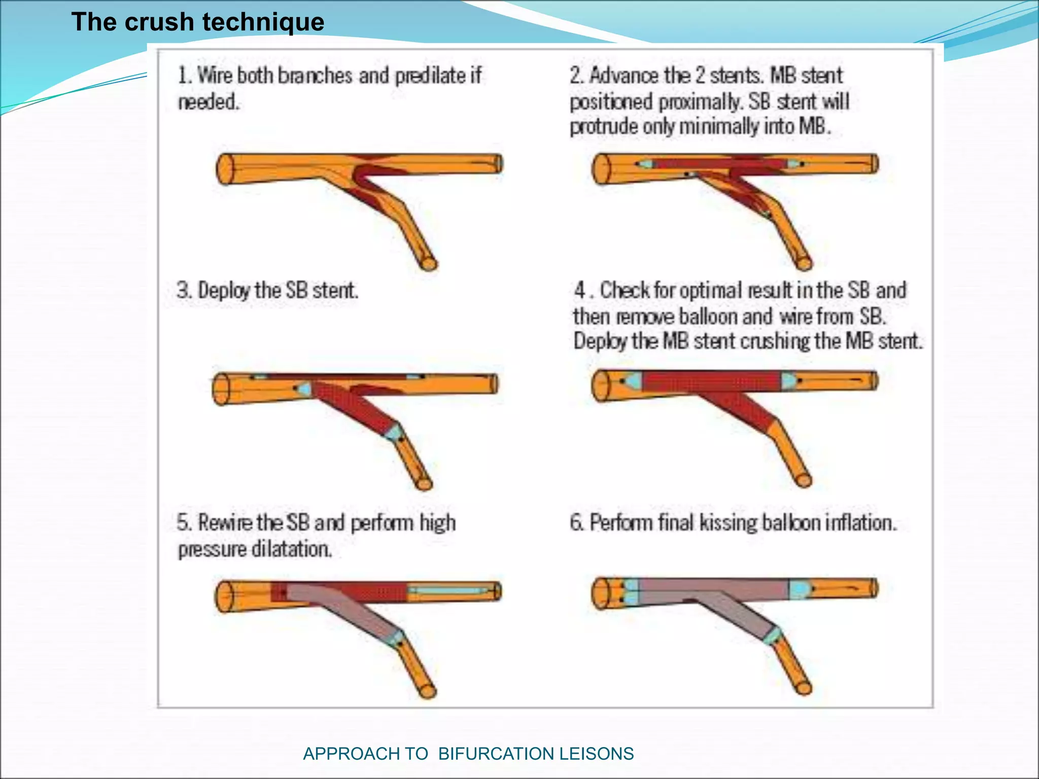 APPROACH TO BIFURCATION LEISONS
The crush technique
 