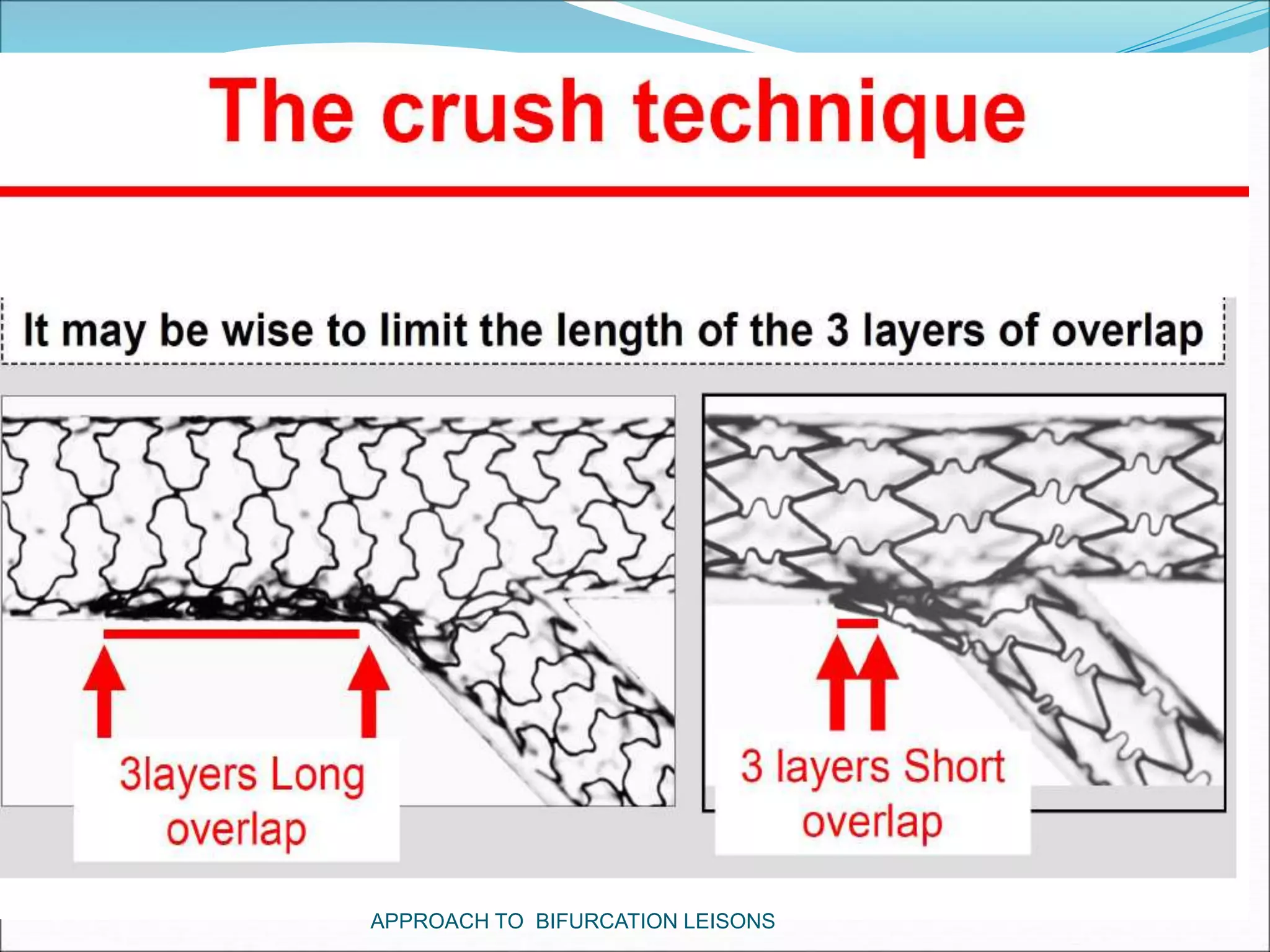 APPROACH TO BIFURCATION LEISONS
 