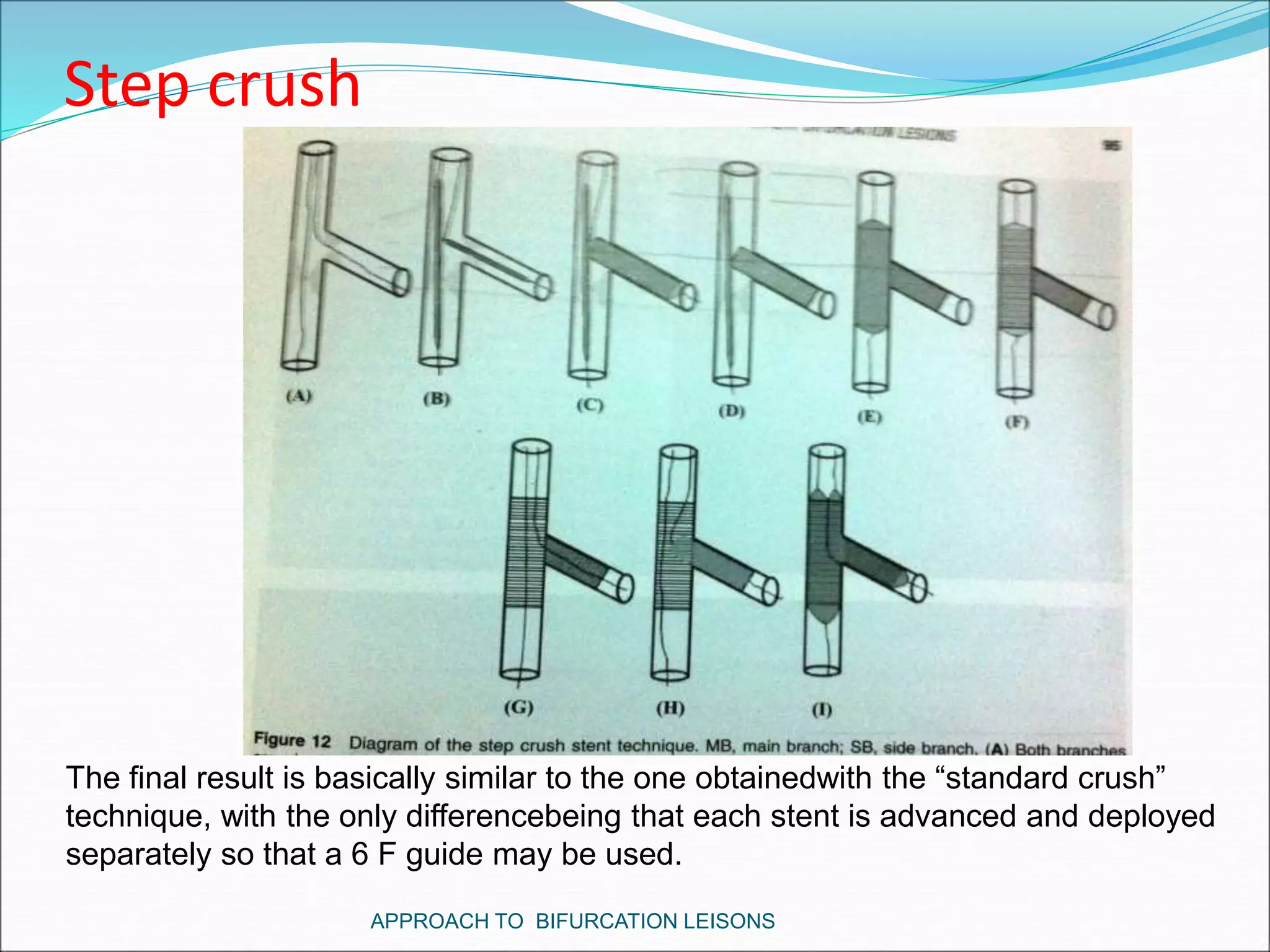 Step crush
The final result is basically similar to the one obtainedwith the “standard crush”
technique, with the only differencebeing that each stent is advanced and deployed
separately so that a 6 F guide may be used.
APPROACH TO BIFURCATION LEISONS
 