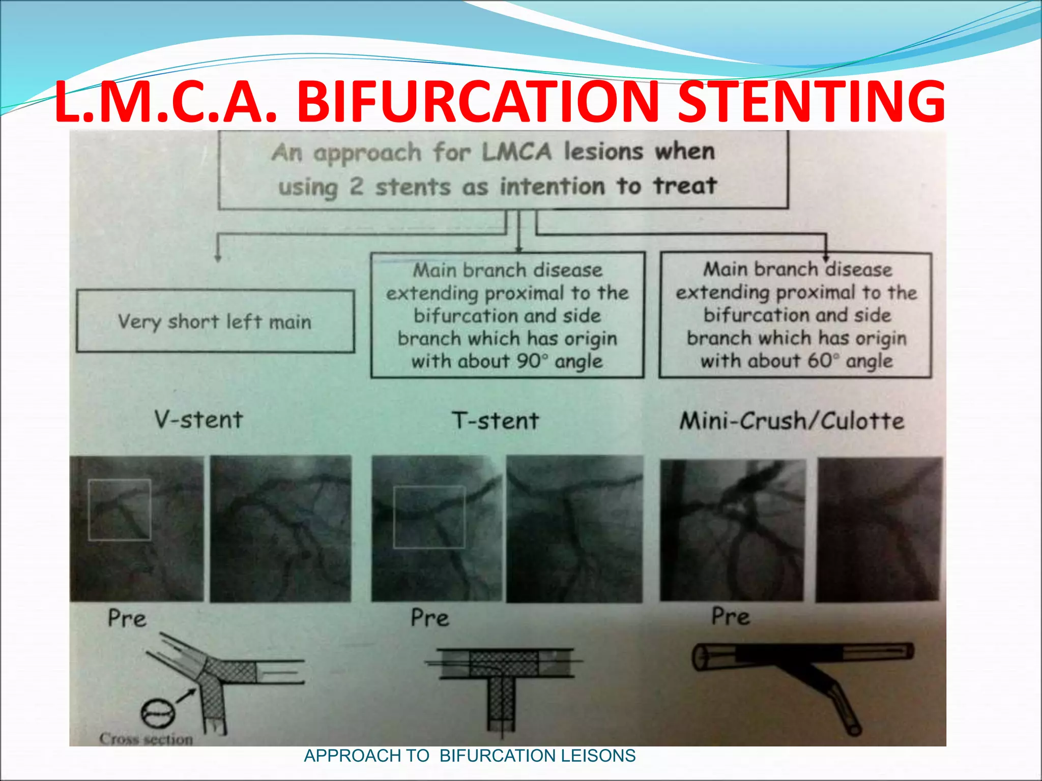 L.M.C.A. BIFURCATION STENTING
APPROACH TO BIFURCATION LEISONS
 