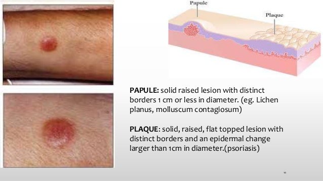 Herpes Zoster Picture Image on MedicineNet.com