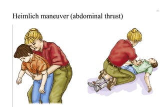Heimlich maneuver (abdominal thrust)
23
 