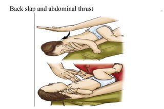 Back slap and abdominal thrust 24
 