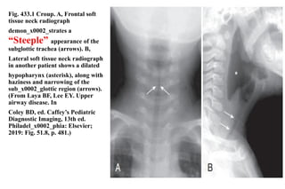 Fig. 433.1 Croup. A, Frontal soft
tissue neck radiograph
demon_x0002_strates a
“Steeple” appearance of the
subglottic trachea (arrows). B,
Lateral soft tissue neck radiograph
in another patient shows a dilated
hypopharynx (asterisk), along with
haziness and narrowing of the
sub_x0002_glottic region (arrows).
(From Laya BF, Lee EY. Upper
airway disease. In
Coley BD, ed. Caffey’s Pediatric
Diagnostic Imaging, 13th ed.
Philadel_x0002_phia: Elsevier;
2019: Fig. 51.8, p. 481.)
33
 