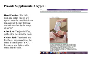 Provide Supplemental Oxygen:
Hand Position: The little,
ring, and index fingers are
spread over the mandible from
the angle of the jaw forward
towards the chin in the shape
of an "E".
●Jaw Lift: The jaw is lifted,
pulling the face into the mask.
●Mask Seal: The thumb and
forefinger are placed over the
mask in the shape of a "C",
forming a seal between the
mask and the skin.
 