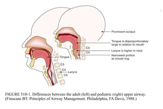 FIGURE 510-1. Differences between the adult (left) and pediatric (right) upper airway.
(Finucane BT: Principles of Airway Management. Philadelphia, FA Davis, 1988.)
9
 