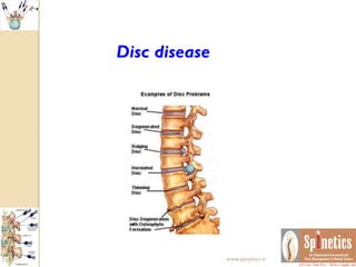 Disc disease
www.spinetics.in
 
