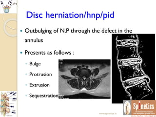 Disc herniation/hnp/pid
 Outbulging of N.P through the defect in the
annulus
 Presents as follows :
◦ Bulge
◦ Protrusion
◦ Extrusion
◦ Sequestration
www.spinetics.in
 