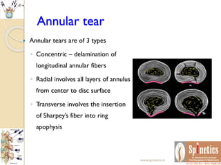 Annular tear
 Annular tears are of 3 types
◦ Concentric – delamination of
longitudinal annular fibers
◦ Radial involves all layers of annulus
from center to disc surface
◦ Transverse involves the insertion
of Sharpey’s fiber into ring
apophysis
www.spinetics.in
 