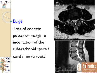  Bulge
Loss of concave
posterior margin ±
indentation of the
subarachnoid space /
cord / nerve roots
www.spinetics.in
 