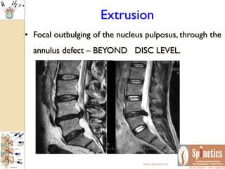 Extrusion
• Focal outbulging of the nucleus pulposus, through the
annulus defect – BEYOND DISC LEVEL.
www.spinetics.in
 