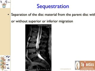 Sequestration
• Separation of the disc material from the parent disc with
or without superior or inferior migration
www.spinetics.in
 