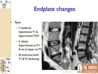 Endplate changes
• Types
– I (oedema)
hypointenseT1 &
hyperintenseT2W
– II (fatty)
hyperintense onT1
& iso to hyper onT2
– III (sclerosis) both
T1 &T2 darkening
www.spinetics.in
 