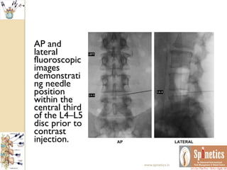 AP and
lateral
fluoroscopic
images
demonstrati
ng needle
position
within the
central third
of the L4–L5
disc prior to
contrast
injection.
www.spinetics.in
 