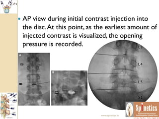  AP view during initial contrast injection into
the disc.At this point, as the earliest amount of
injected contrast is visualized, the opening
pressure is recorded.
www.spinetics.in
 