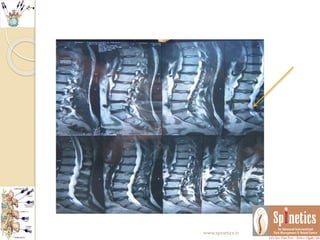 www.spinetics.in
 