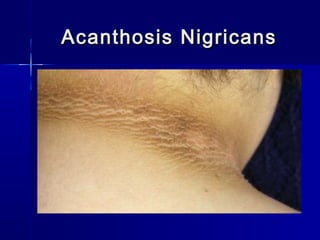 Acanthosis NigricansAcanthosis Nigricans
 