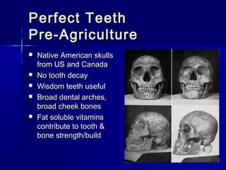 Perfect TeethPerfect Teeth
Pre-AgriculturePre-Agriculture
 Native American skullsNative American skulls
from US and Canadafrom US and Canada
 No tooth decayNo tooth decay
 Wisdom teeth usefulWisdom teeth useful
 Broad dental arches,Broad dental arches,
broad cheek bonesbroad cheek bones
 Fat soluble vitaminsFat soluble vitamins
contribute to tooth &contribute to tooth &
bone strength/buildbone strength/build
 