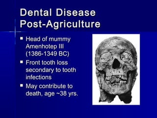 Dental DiseaseDental Disease
Post-AgriculturePost-Agriculture
 Head of mummyHead of mummy
Amenhotep IIIAmenhotep III
(1386-1349 BC)(1386-1349 BC)
 Front tooth lossFront tooth loss
secondary to toothsecondary to tooth
infectionsinfections
 May contribute toMay contribute to
death, age ~38 yrs.death, age ~38 yrs.
 